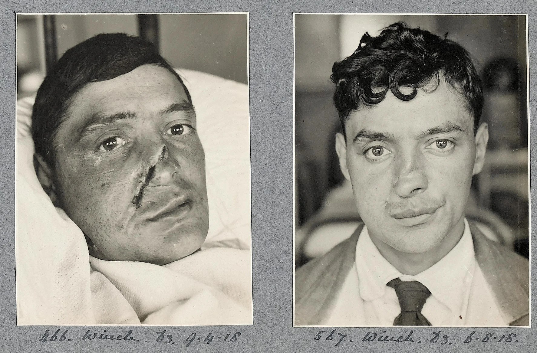 Photos Showcase Pioneering Plastic Surgeon's Work on WW1 Soldiers