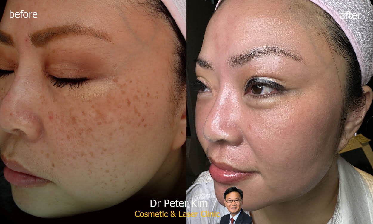 Laser Freckle Removal Dr Peter Kim Surgery Skin Cancer, Cosmetic