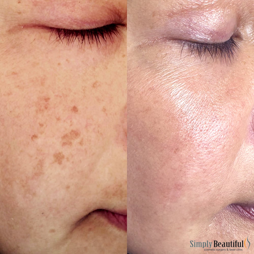 Laser Skin Whitening (Rejuvenation) Dr Peter Kim Surgery Skin