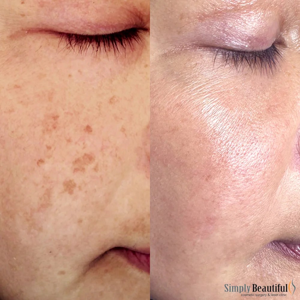 Laser Skin Whitening (Rejuvenation) Dr Peter Kim Surgery Skin Cancer, Cosmetic & Laser Clinic