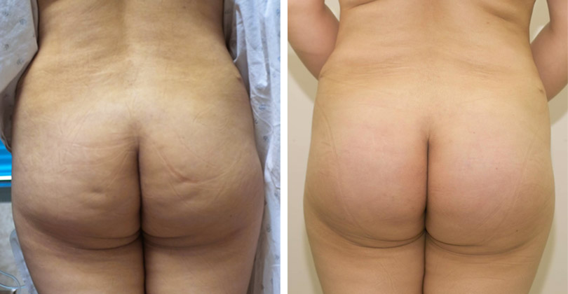 Cellulite Why We Have It And How To Get Rid Of It Pfitblog