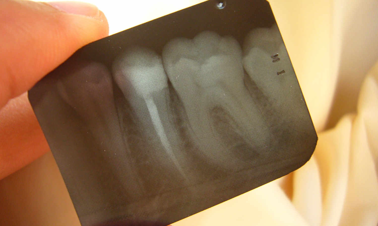 Root Canal Therapy in Pittsburgh & Sewickley PA Innovative Endodontics