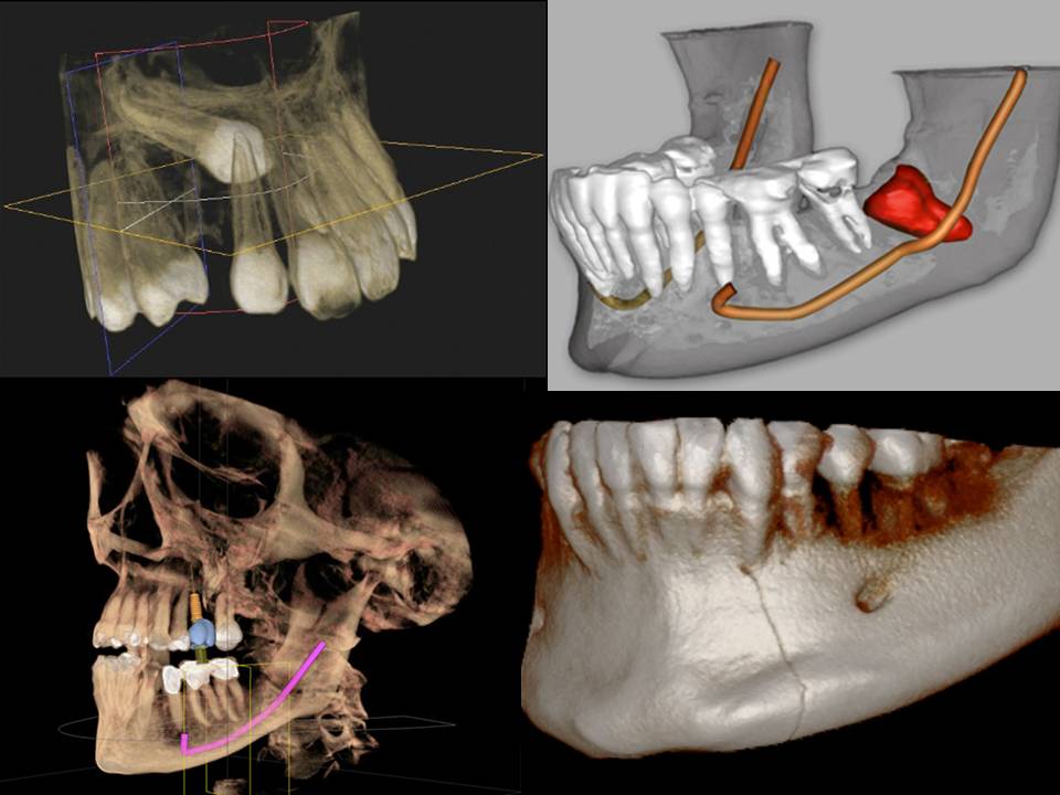 Cone Beam Computed Tomography (3D CBCT) Phan Endodontic Partners