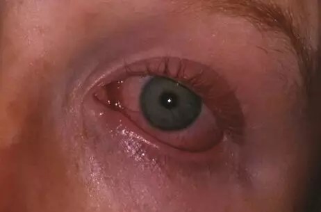 Eye Disorders: Understanding The Causes, Symptoms And Management - The Pharmaceutical Journal