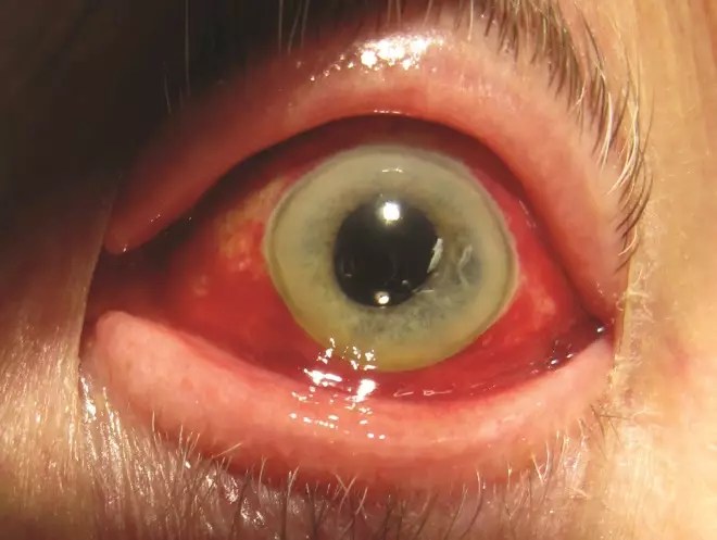 Eye Disorders: Understanding The Causes, Symptoms And Management - The Pharmaceutical Journal