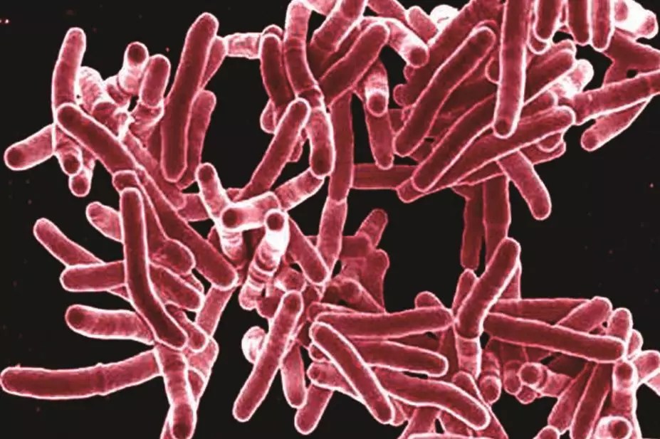 Tuberculosis clinical features and diagnosis The