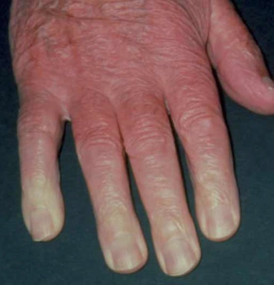 Managing Raynaud’s phenomenon The Pharmaceutical Journal