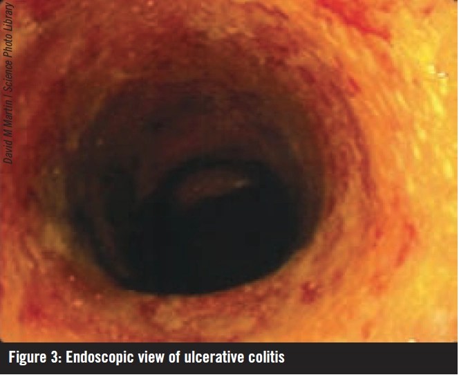 Inflammatory bowel disease clinical features and diagnosis The Pharmaceutical Journal