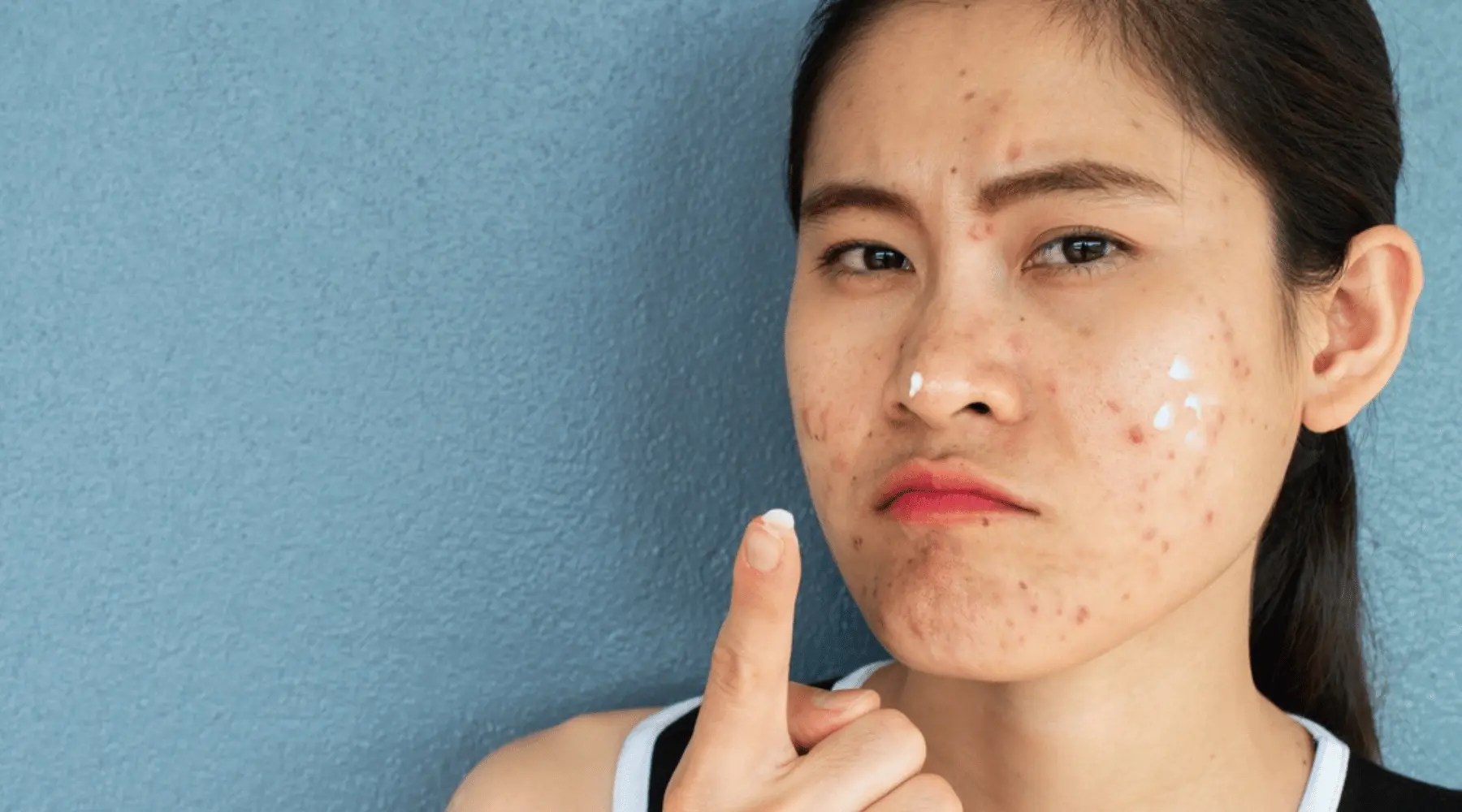 Can Sunscreen Cause Acne? Unraveling Skincare Myths & Facts