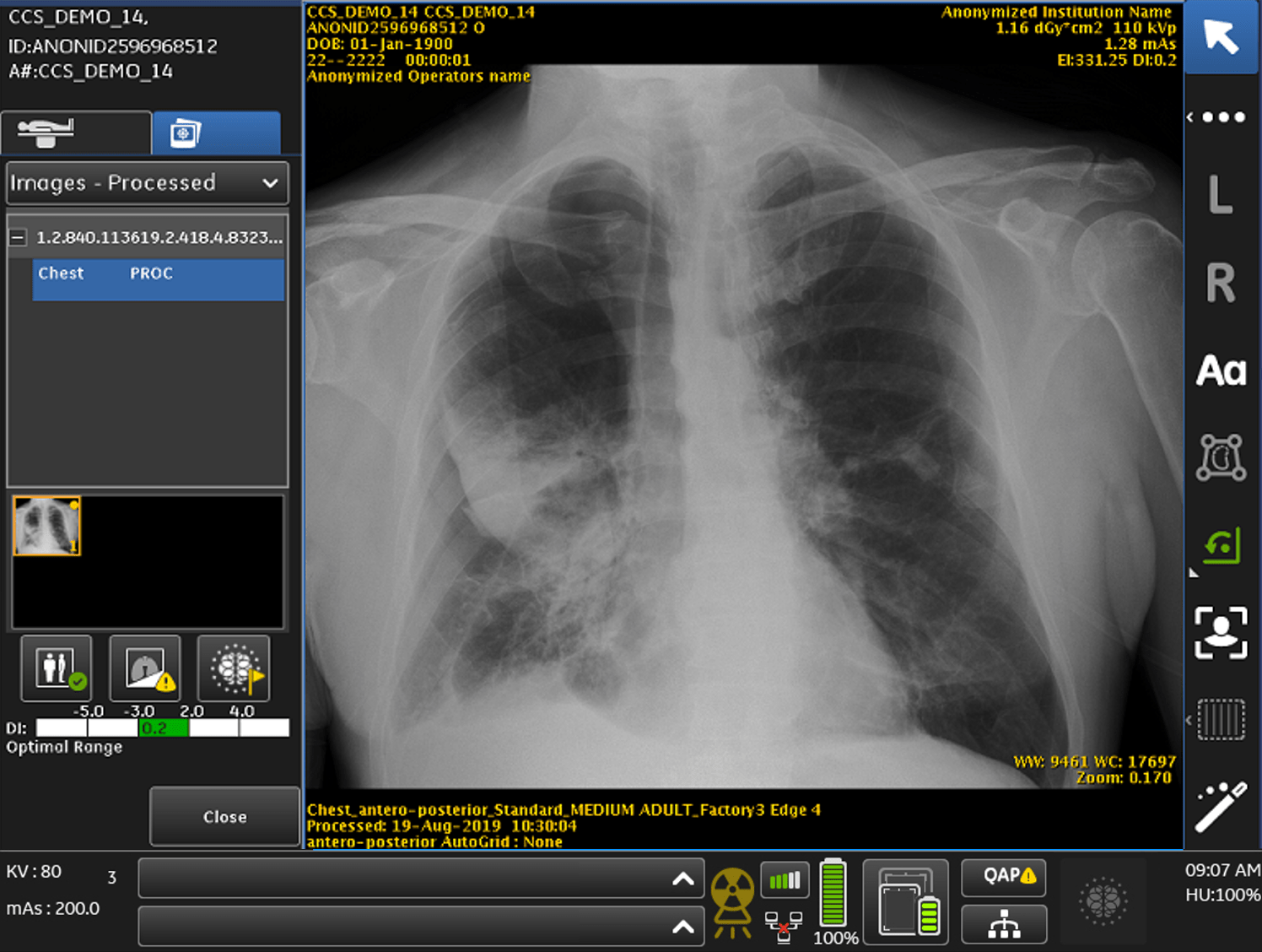 FDA approves GE's AIbased collapsed lung detection system pharmaphorum