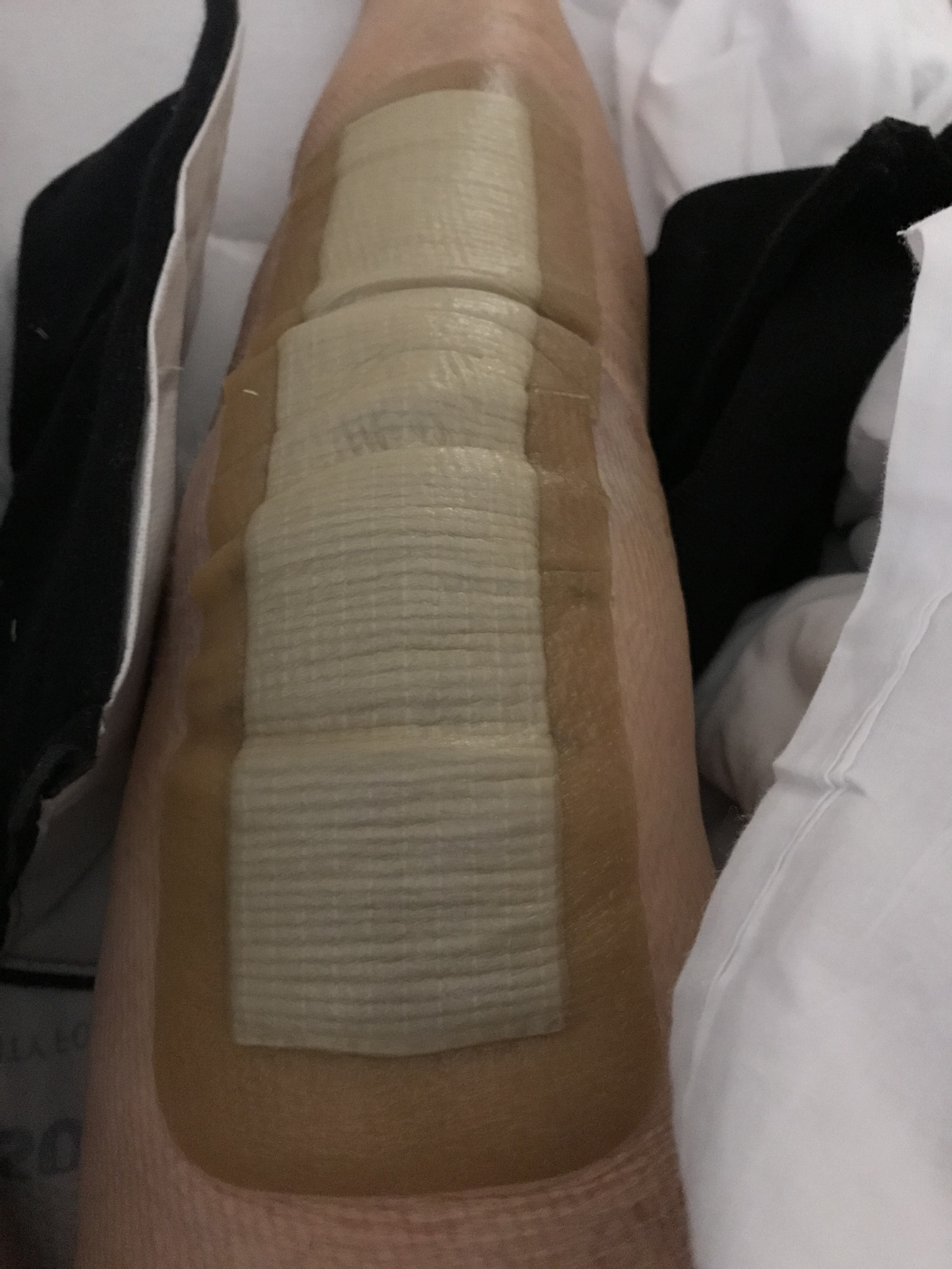 Bilateral Double Knee ReplacementPart 1 Surgery Country Chatter