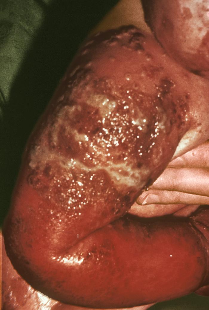 Details Public Health Image Library(PHIL)