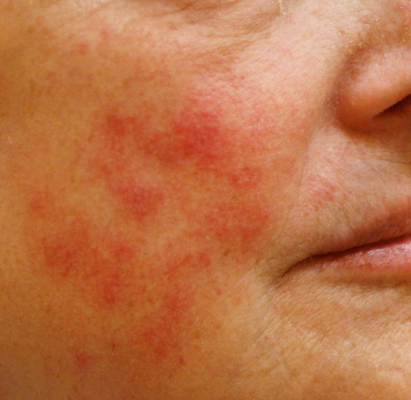 Rosacea Treatment & Medication, Philadelphia Rosacea Laser Therapy, PA