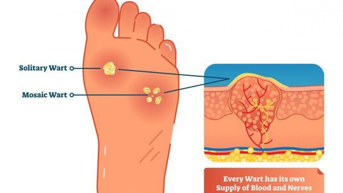 Warts Removal Naturally Philadelphia Holistic Clinic Dr. Tsan & his