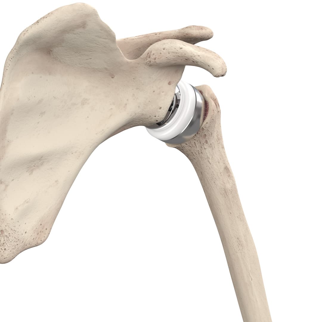 Stryker ReUnion S – Portfolio