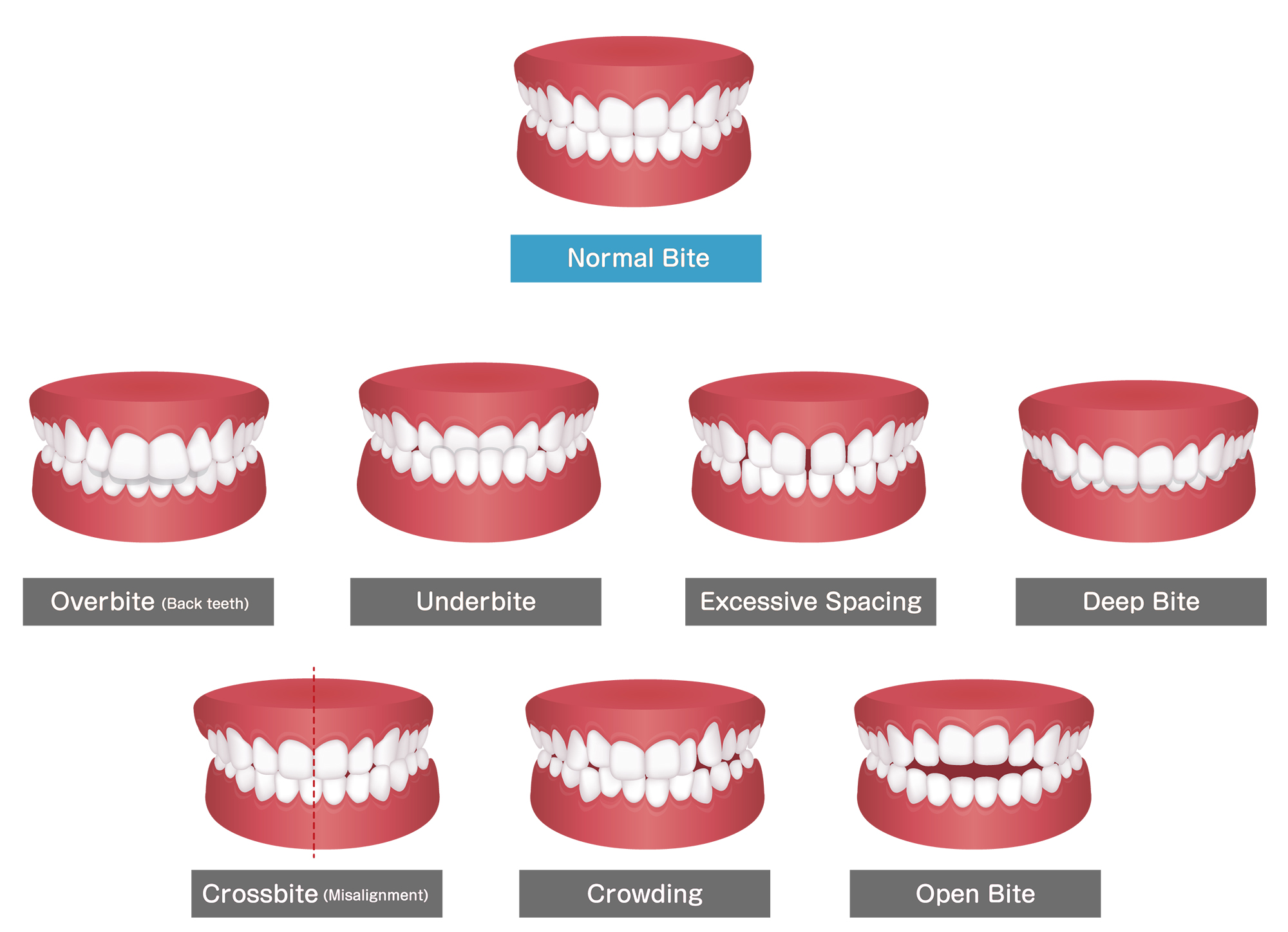 Bite Balancing Philippe Athuil, DDS