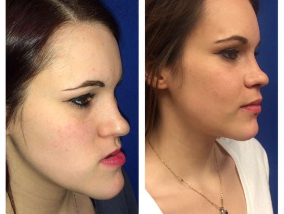 Orthognathic Jaw Surgery Oral Surgeon in Philadelphia