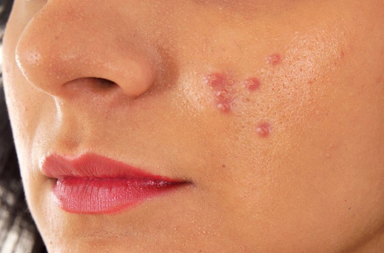 ACNE Different Types Of This Face Condition & Its Treatment