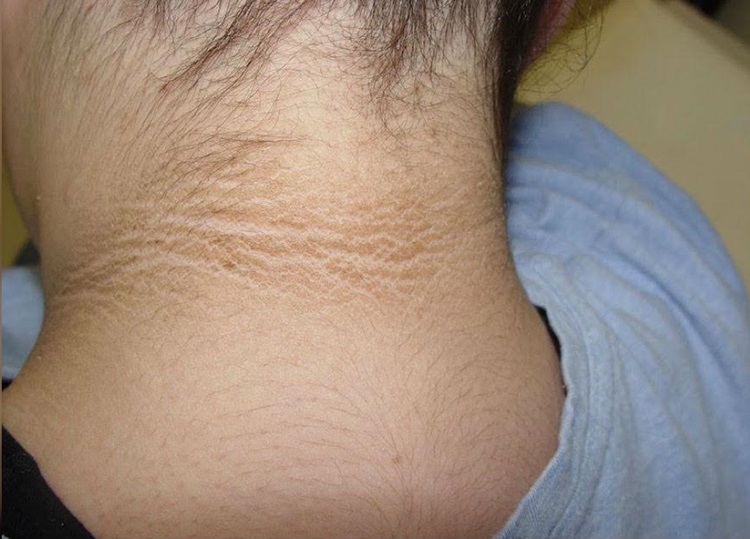 Get Rid of Dark Neck With These Natural Remedies Causes & Diagnosis