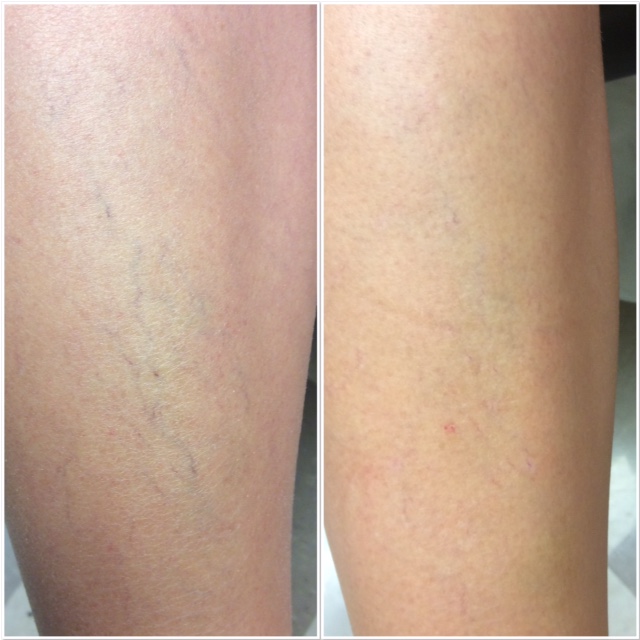 LEG VEINS Phoenix Tattoo Removal
