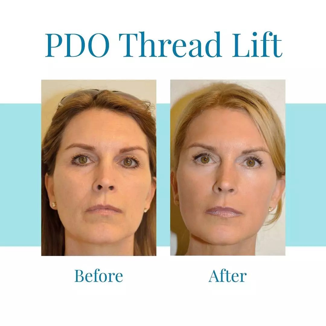 Discover the Magic of PDO Thread Lift for Eyes