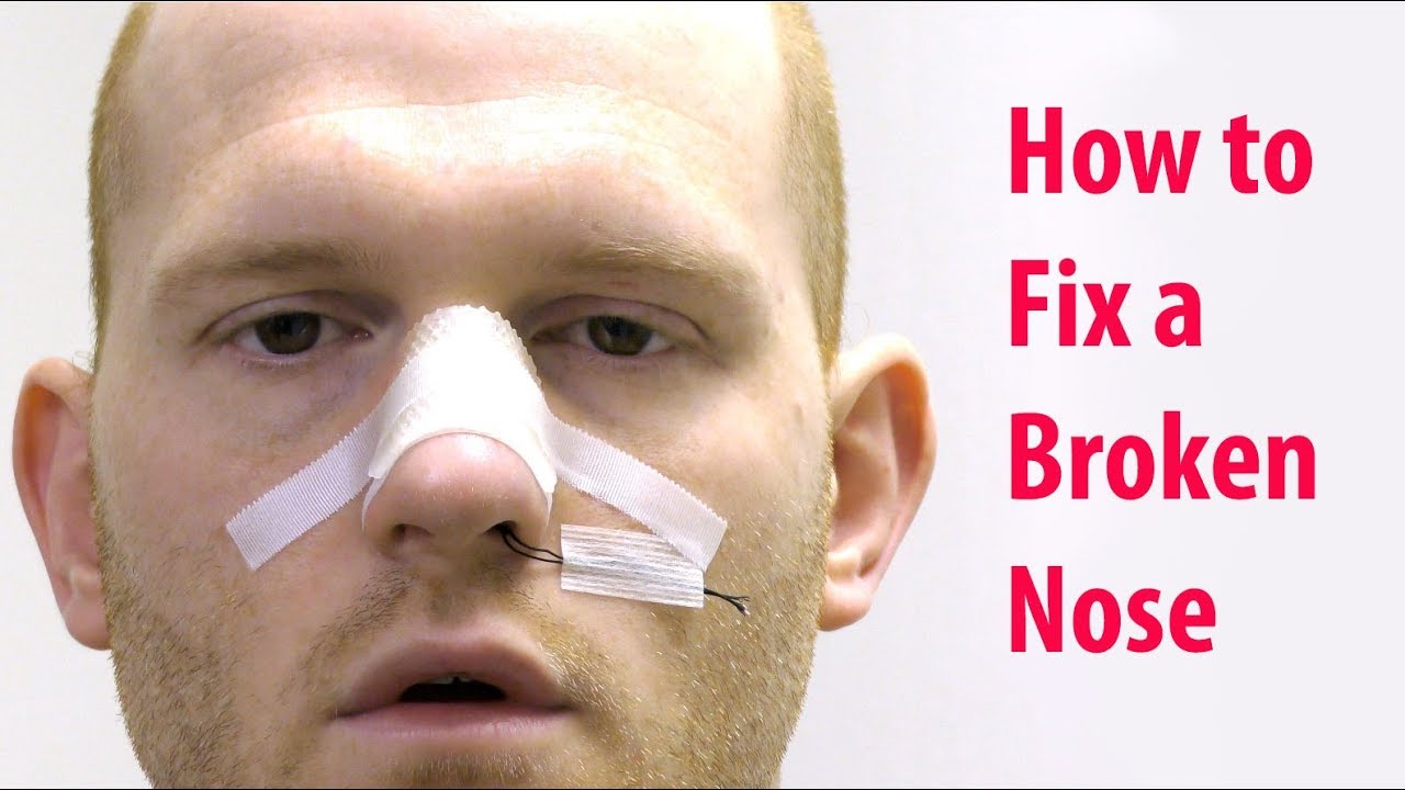 Dealing with a Broken Nose Causes, Symptoms, and Treatment