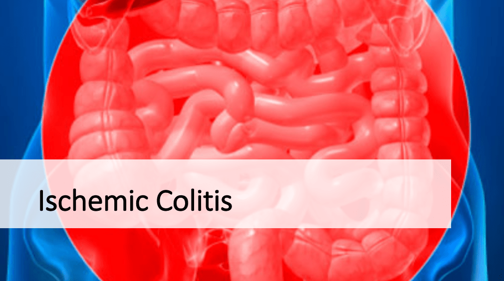 Ischemic Colitis Causes, Symptoms, and Management
