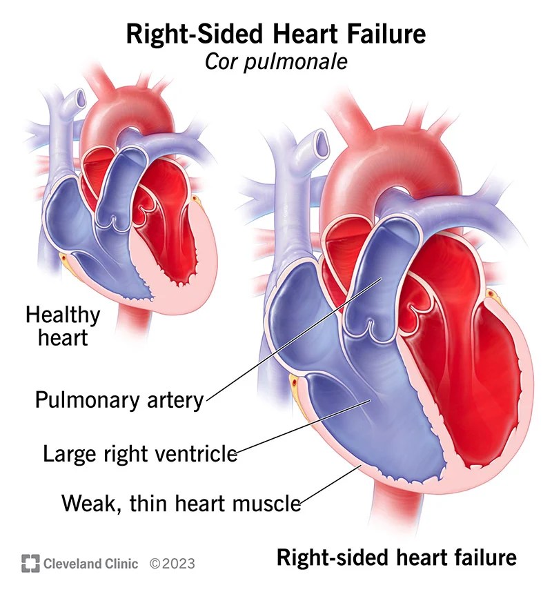Right Sided Heart Failure Causes, Symptoms, and Treatment