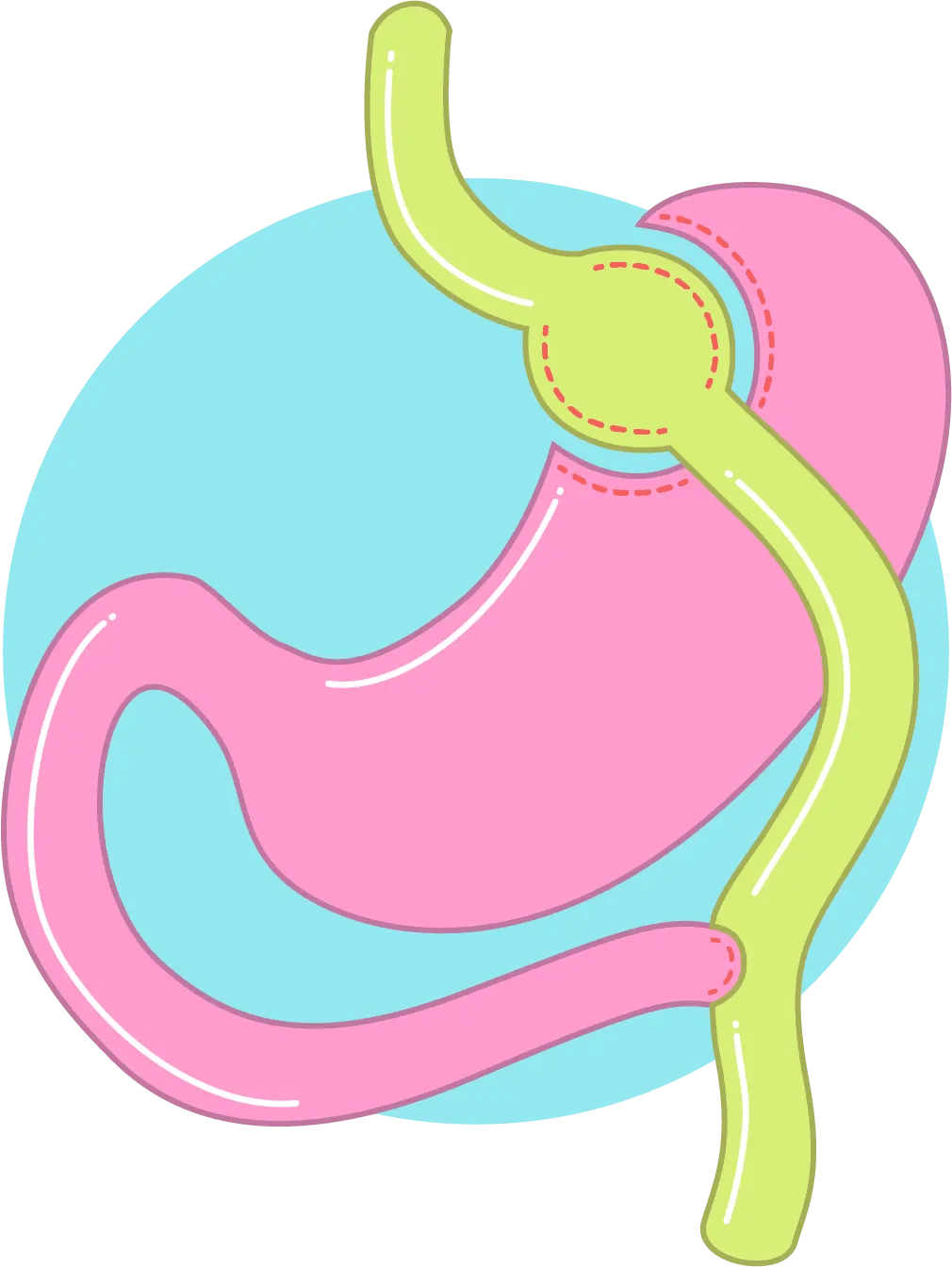Gastric Bypass phorma