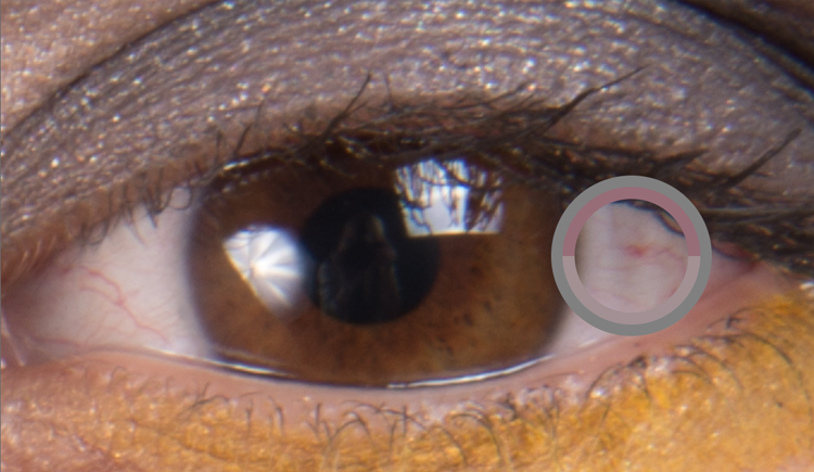 Removal of the veins in the eyes