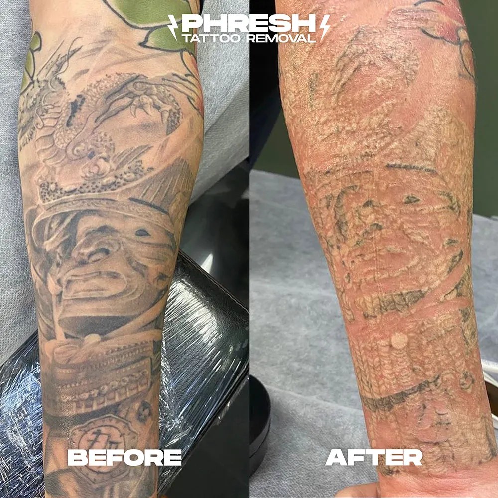 Discover 64+ full sleeve tattoo removal in.eteachers