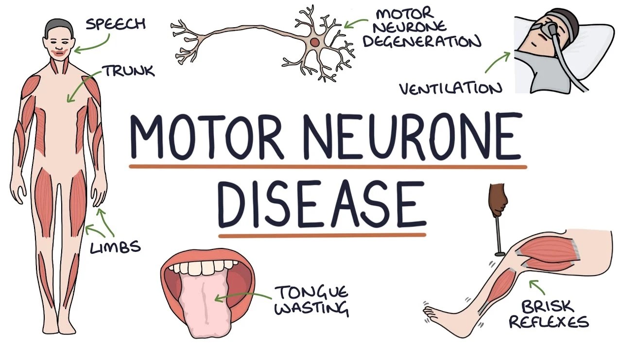 Motor Neuron Disease (MND) Causes, Symptoms, Treatment