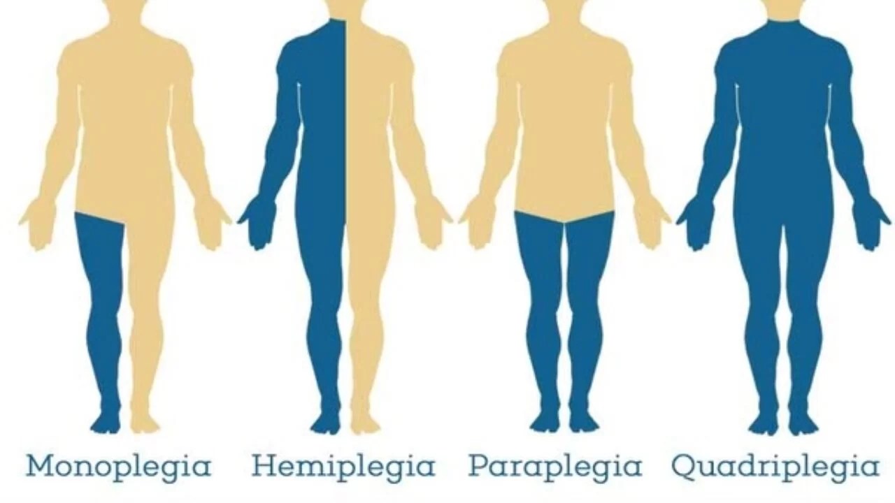 Paraplegia Causes, Symptoms, Types & Treatment
