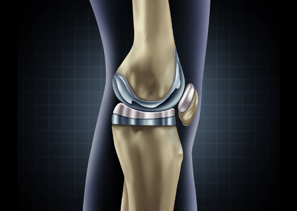 7 Most Common Symptoms of a Loose Knee Replacement