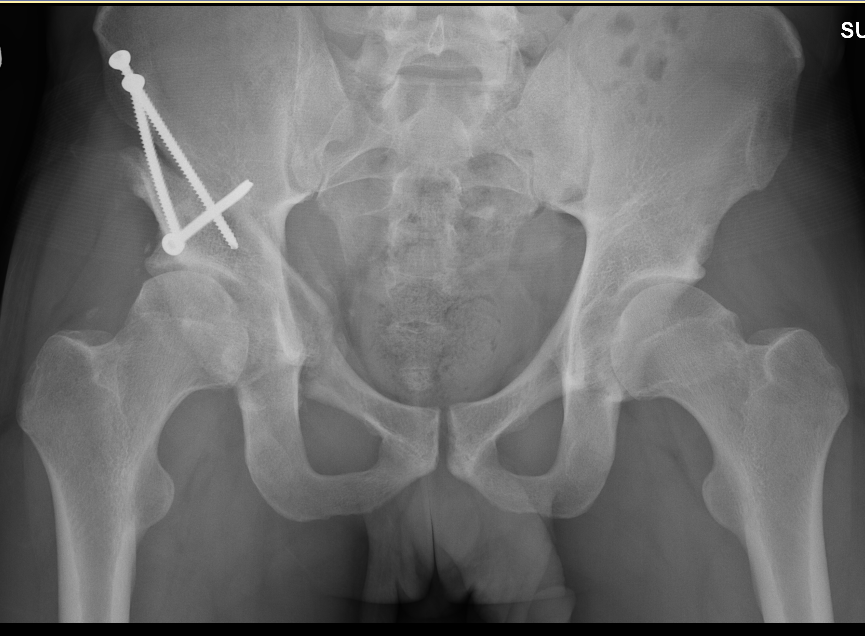 Damaged Hip Cartilage Replaced with FirstofitsKind Procedure Duke