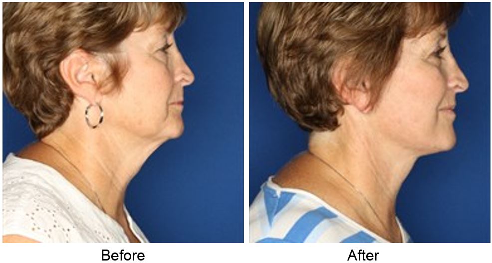 Facelift & Necklift Gallery Louisville, KY Dr. Sean Maguire