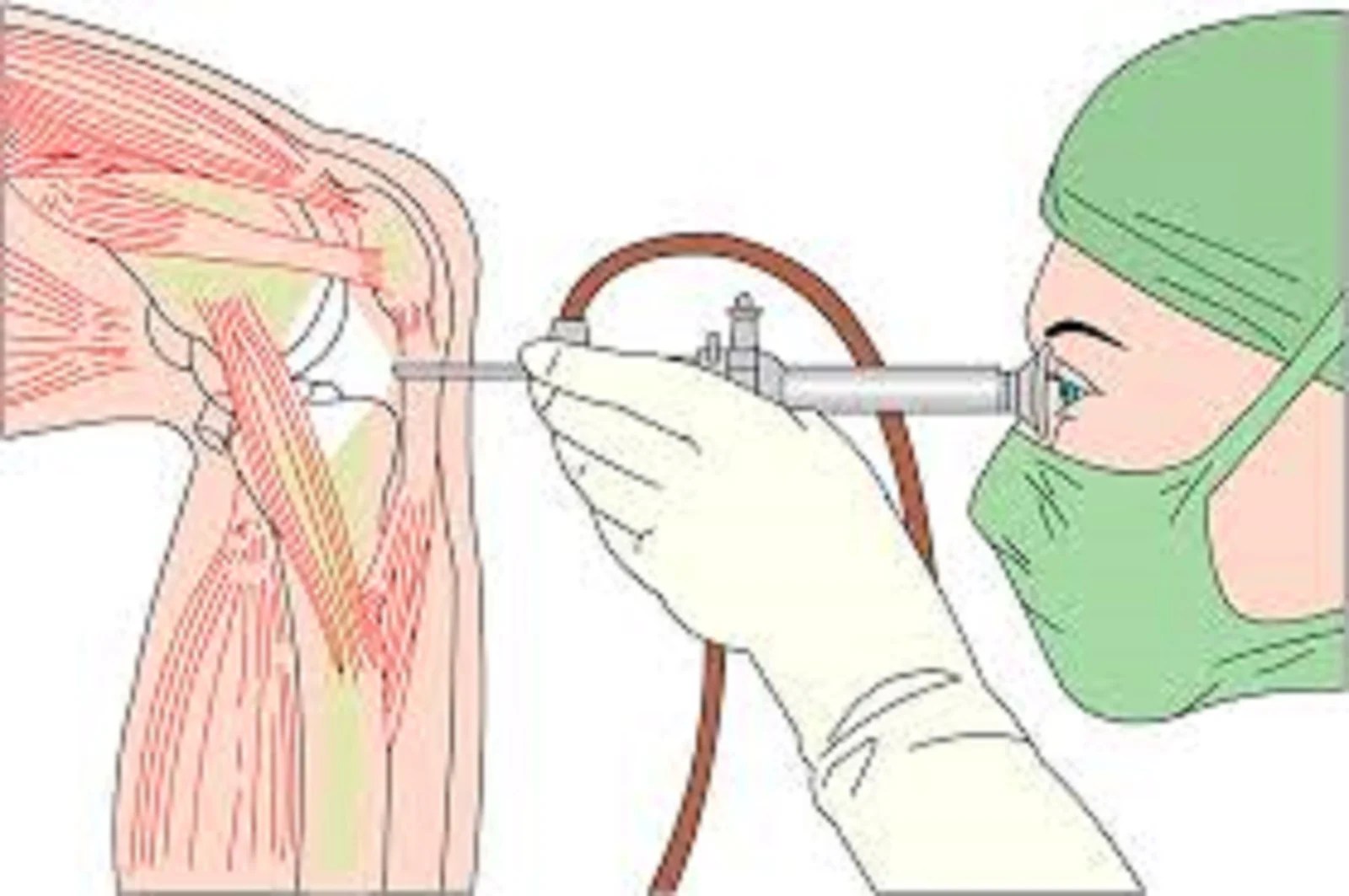 Types of Surgery for Osteoarthritis Physicians Options Physician