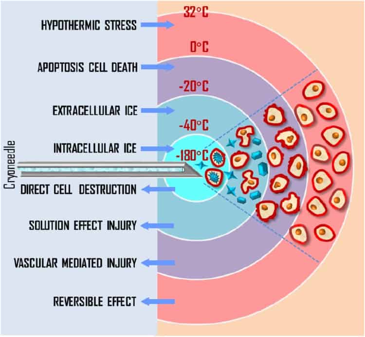 OA imaging takes control of prostate cryotherapy Physics World