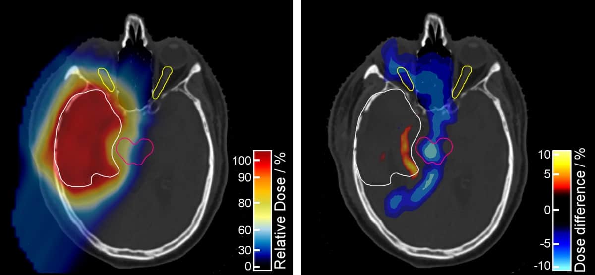 Dualenergy CT for proton therapy planning reaches the clinic Physics