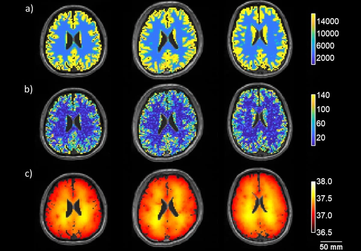 Personalized brain temperature maps created using MRI and biophysical