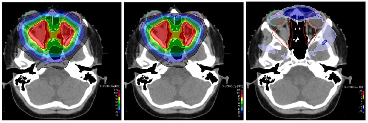 Static Apertures Keep Dose On Target In Pencil-Beam Scanning Proton Therapy – Physics World 401_x_1200_jpg