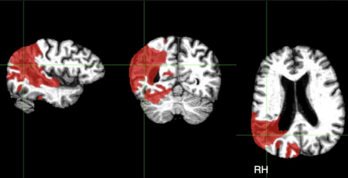 Multimodal MRI reveals brain areas that can still ‘see’ after a stroke