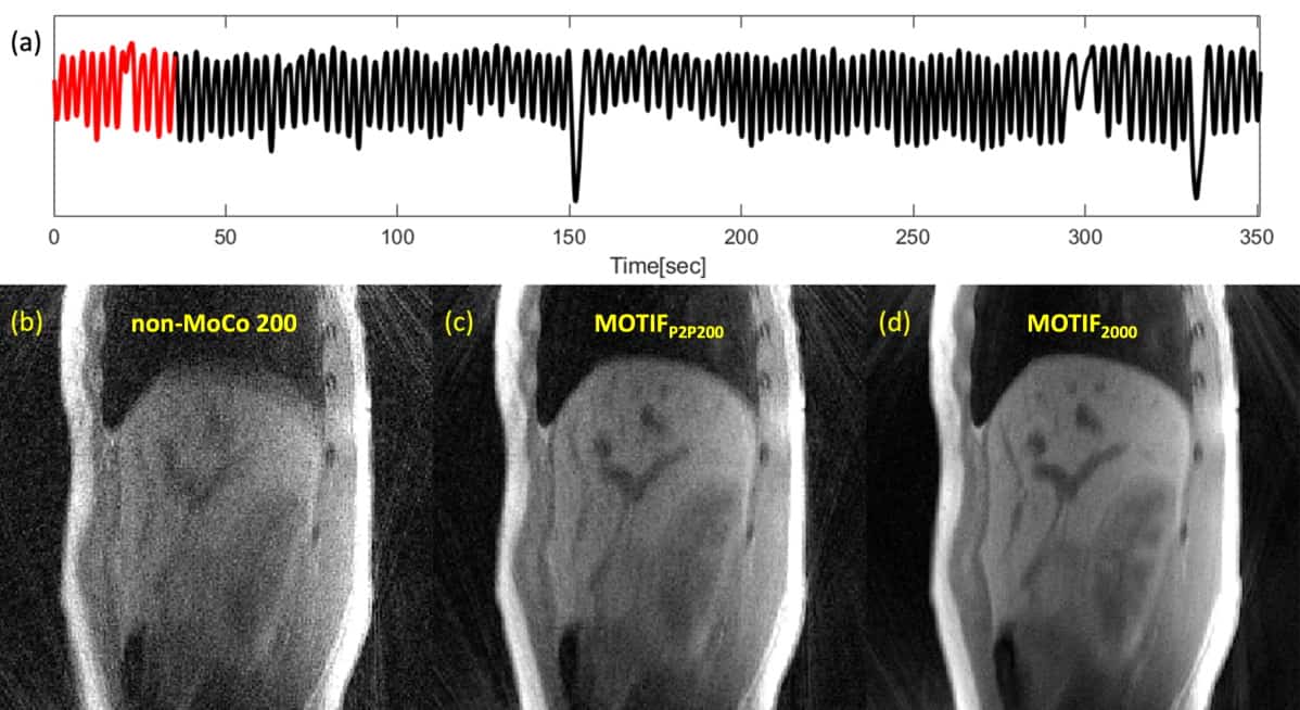 A single MRI scan can manage respiratory motion Physics World