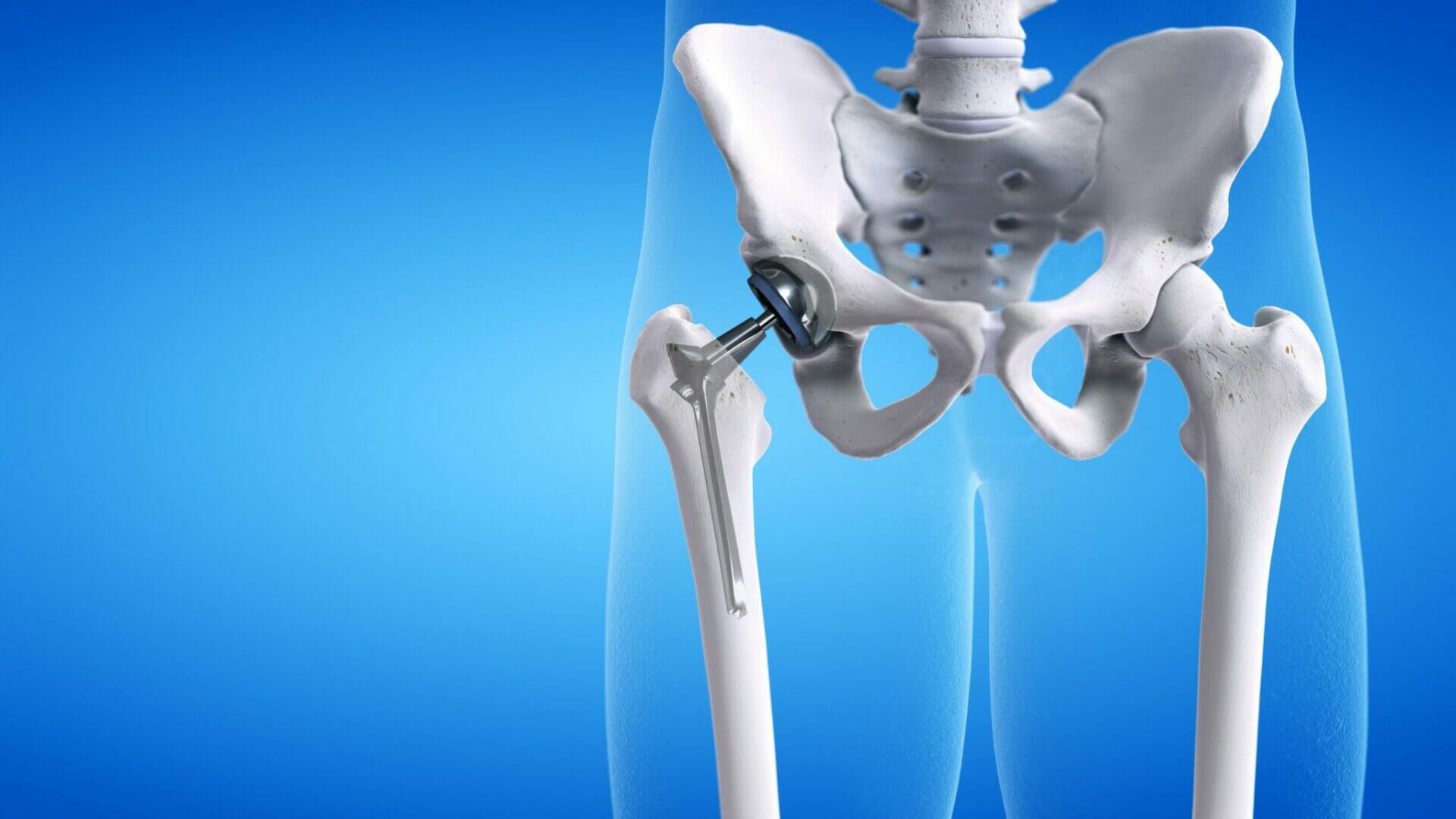 What Do You Need For Hip Replacement Recovery at Howard Sisk blog