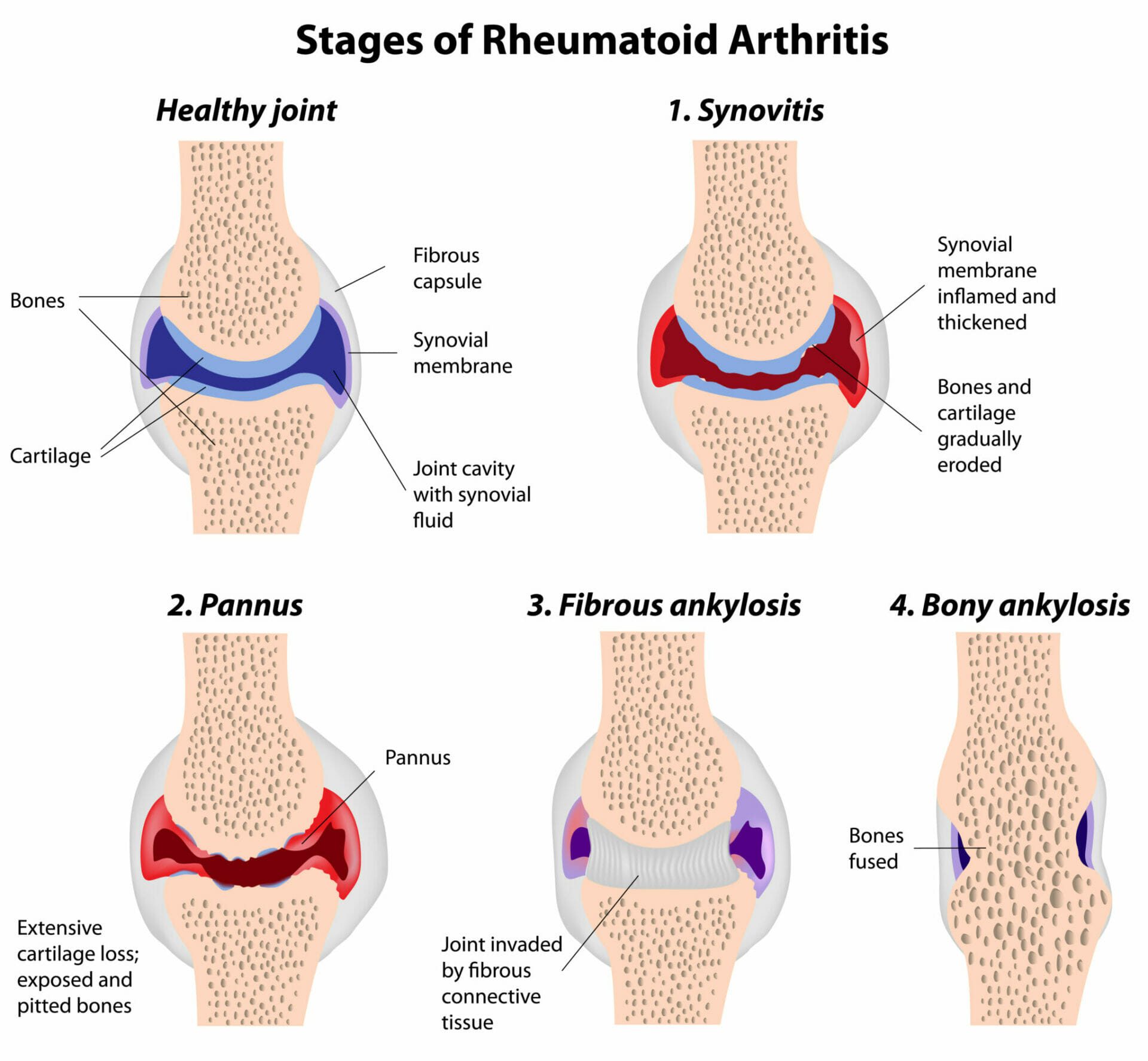 Stages of rheumatoid arthritis Physiological