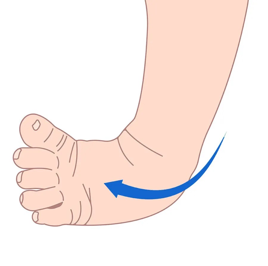 Clubfoot (for Parents) Physiotherapist in Richmond Hill