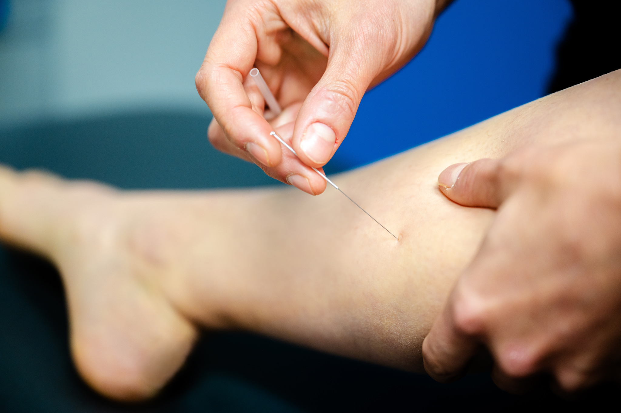 Puncture physiothérapique avec aiguilles sèches (PPAS) Physio Amplitude