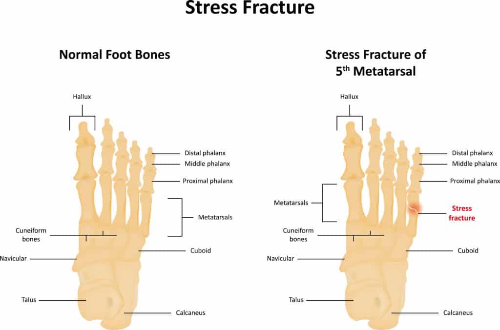 Stress Fracture Symptoms What You Need To Know Physio Ed.