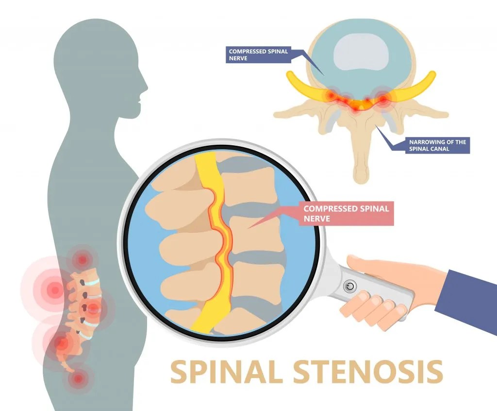 Cervical Spinal Stenosis Vancouver, WA Physical Therapy Sports