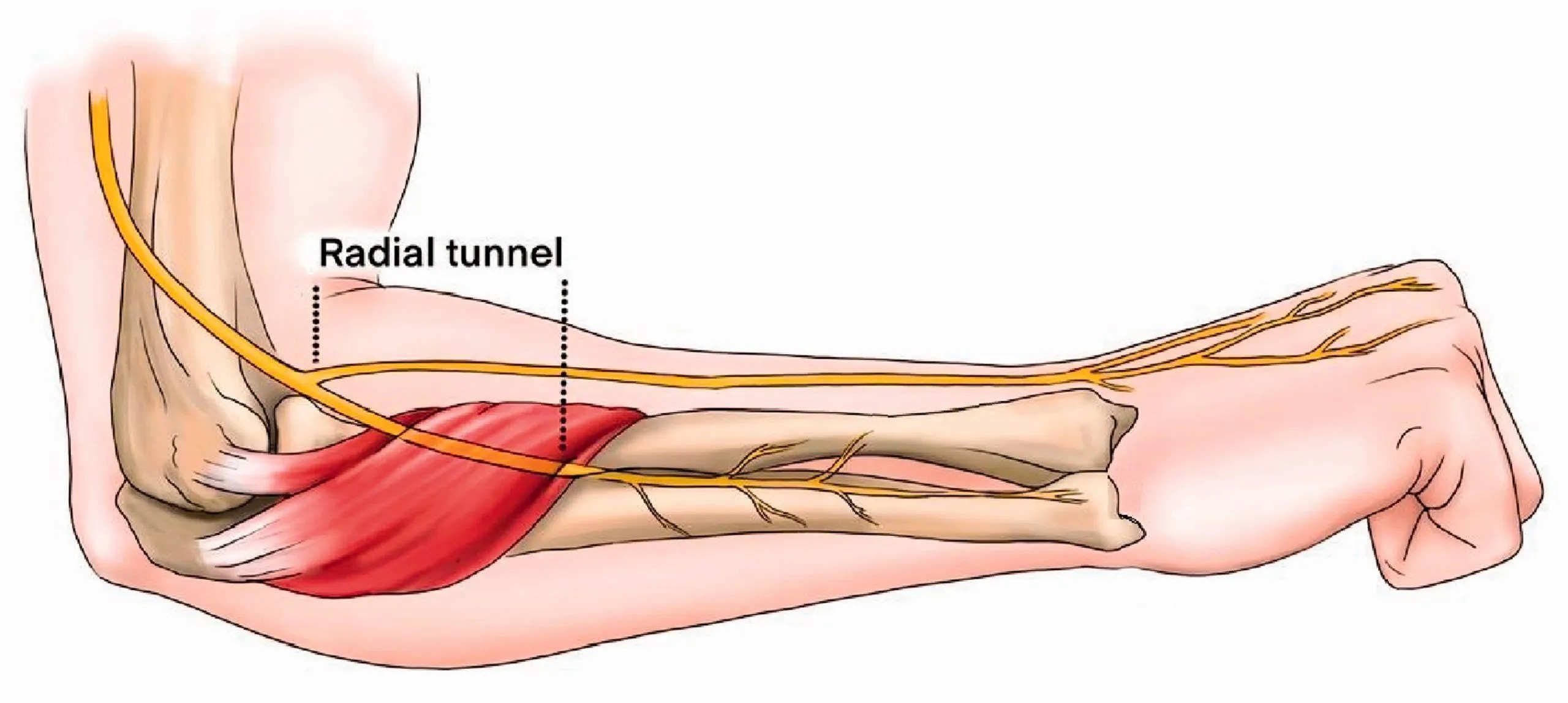 Radial Tunnel Syndrome Physioflow PT Physical Therapy Vancouver, WA